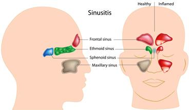 Severe Sinus Pain: What to Do? - Socal Sinus
